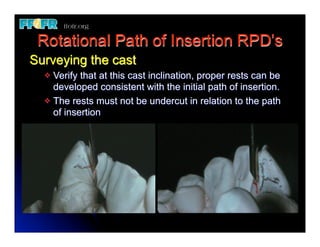 Rotational Path of Insertion RPD’s
Surveying the cast
  v Verify that at this cast inclination, proper rests can be
     developed consistent with the initial path of insertion.
  v The rests must not be undercut in relation to the path
     of insertion
 