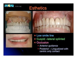 Esthetics




  v Low smile line
  v Cuspid –lateral splinted
  v Occlusion
       v Anterior guidance
       v Posterior – Lingualized with
          centric only contact
 
