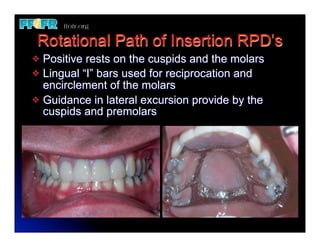Rotational Path of Insertion RPD’s
v Positive rests on the cuspids and the molars
v Lingual “I” bars used for reciprocation and
   encirclement of the molars
v Guidance in lateral excursion provide by the
   cuspids and premolars
 