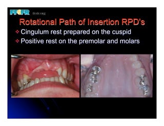 Rotational Path of Insertion RPD’s
v Cingulum   rest prepared on the cuspid
v Positive rest on the premolar and molars
 