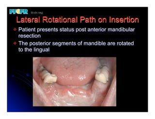 (Replace) 11.esthetics, rotational path, attachments | PDF