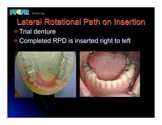 Lateral Rotational Path on Insertion
v Trial
      denture
v Completed RPD is inserted right to left
 