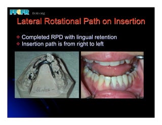 Lateral Rotational Path on Insertion
v Completed RPD with lingual retention
v Insertion path is from right to left
 