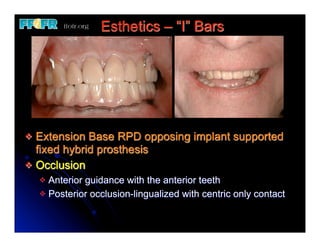 Esthetics – “I” Bars




v Extension Base RPD opposing implant supported
   fixed hybrid prosthesis
v Occlusion
     v Anterior guidance with the anterior teeth
     v Posterior occlusion-lingualized with centric only contact
 