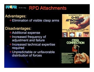 RPD Attachments
Advantages:
  v Elimination   of visible clasp arms

Disadvantages:
  v Additional  expense
  v Increased frequency of
     adjustment and failure
  v Increased technical expertise
     required
  v Unpredictable or unfavorable
     distribution of forces
 