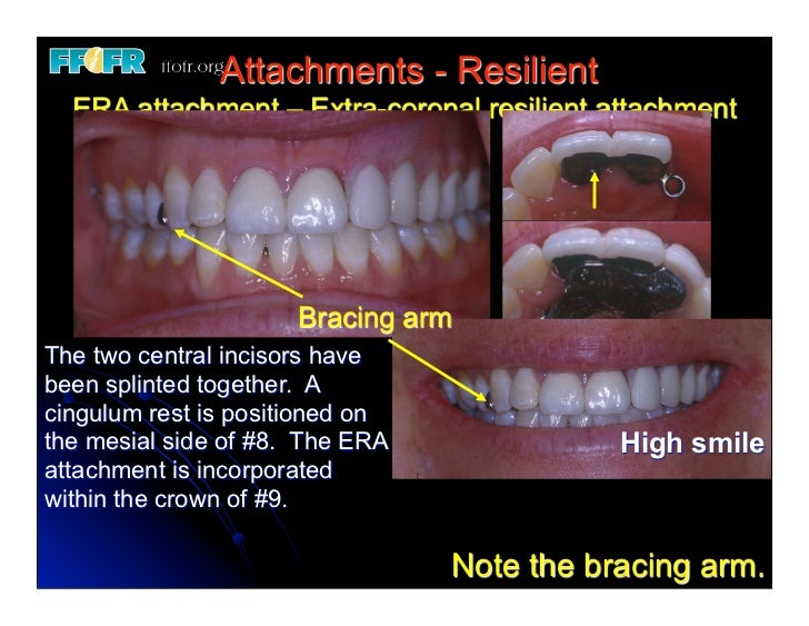 (Replace) 11.esthetics, rotational path, attachments
