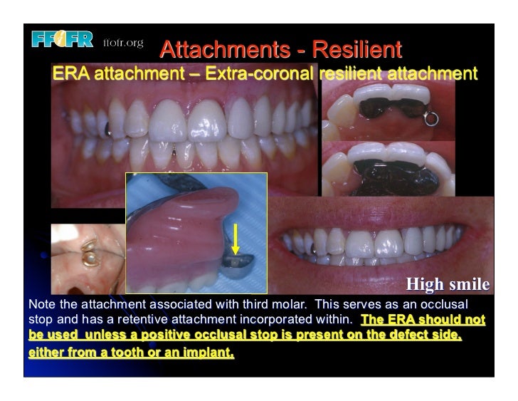 (Replace) 11.esthetics, rotational path, attachments