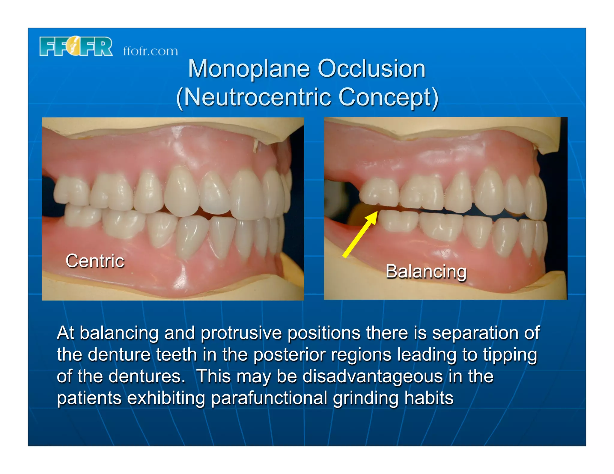 Monoplane Occlusion
              (Neutrocentric Concept)




 Centric
                                         Balancing


At balancing and protrusive positions there is separation of
the denture teeth in the posterior regions leading to tipping
of the dentures. This may be disadvantageous in the
patients exhibiting parafunctional grinding habits
 