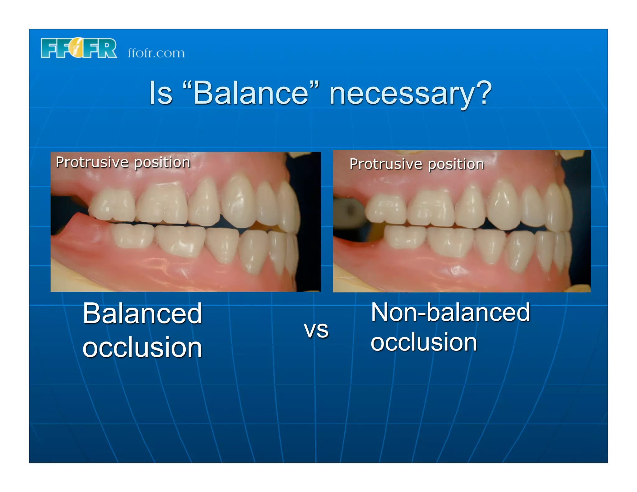 Is “Balance” necessary?
Protrusive position         Protrusive position




   Balanced            vs
                              Non-balanced
   occlusion                  occlusion
 