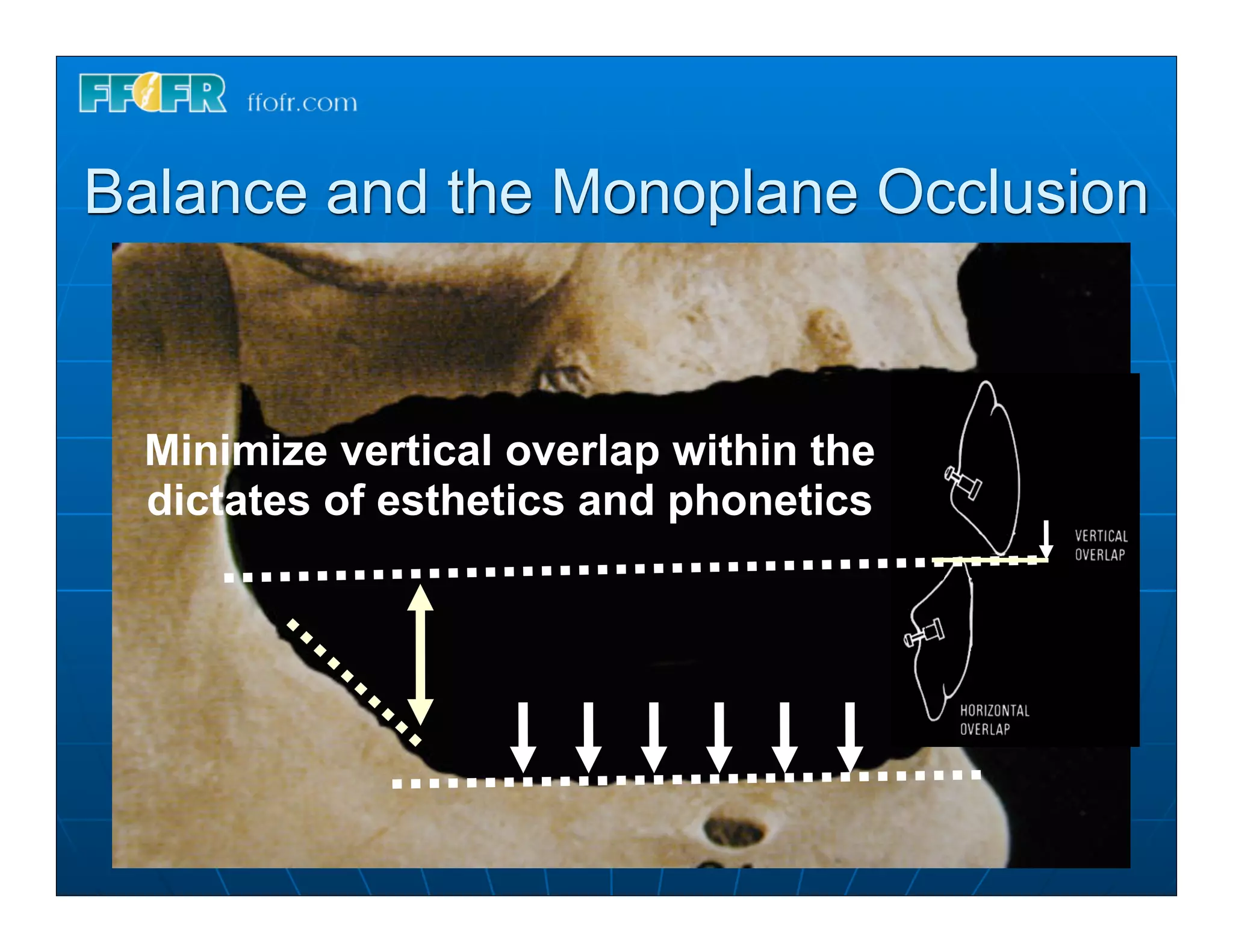 Balance and the Monoplane Occlusion



 Minimize vertical overlap within the
 dictates of esthetics and phonetics
 