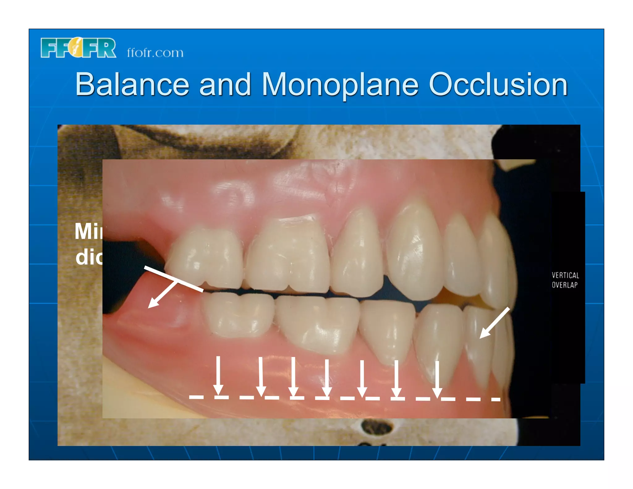 Balance and Monoplane Occlusion



Minimize vertical overlap within the
dictates of esthetics and phonetics
 