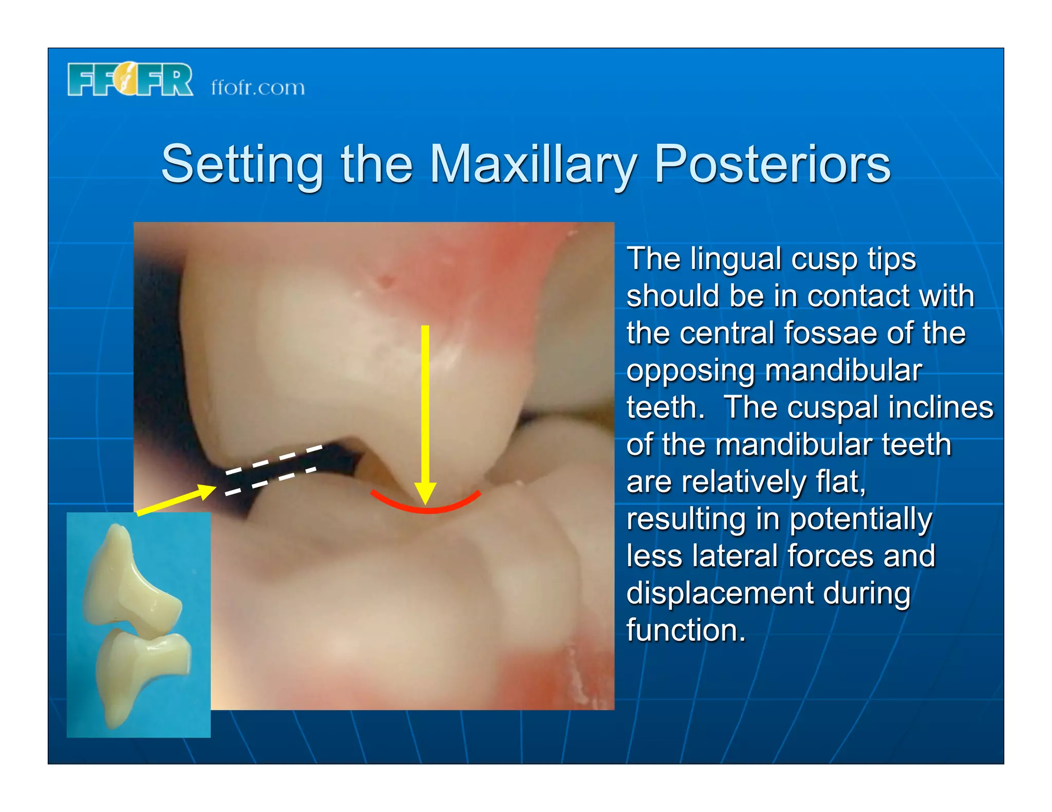 Setting the Maxillary Posteriors
                    The lingual cusp tips
                    should be in contact with
                    the central fossae of the
                    opposing mandibular
                    teeth. The cuspal inclines
                    of the mandibular teeth
                    are relatively flat,
                    resulting in potentially
                    less lateral forces and
                    displacement during
                    function.
 