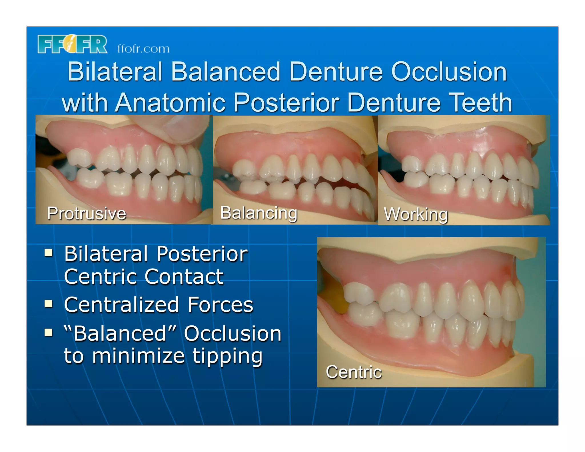 Bilateral Balanced Denture Occlusion
     with Anatomic Posterior Denture Teeth



Protrusive         Balancing             Working

n   Bilateral Posterior
     Centric Contact
n   Centralized Forces
n   “Balanced” Occlusion
     to minimize tipping
                               Centric
 