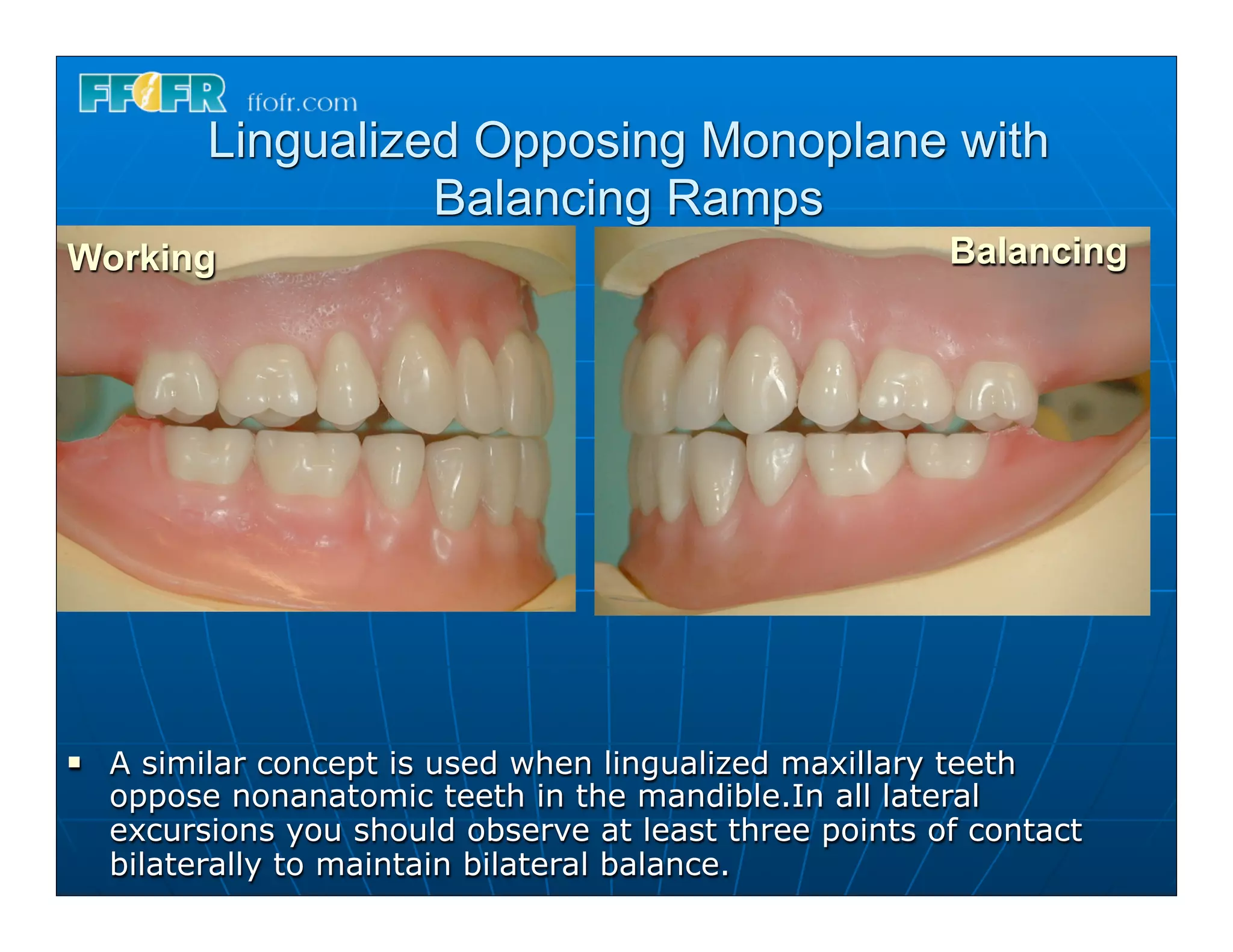 Lingualized Opposing Monoplane with
                     Balancing Ramps
Working                                                   Balancing




n   A similar concept is used when lingualized maxillary teeth
     oppose nonanatomic teeth in the mandible.In all lateral
     excursions you should observe at least three points of contact
     bilaterally to maintain bilateral balance.
 