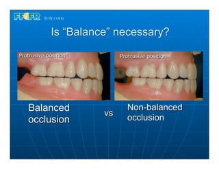 Is “Balance” necessary?
Protrusive position         Protrusive position




   Balanced            vs
                              Non-balanced
   occlusion                  occlusion
 