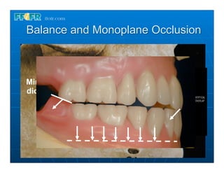 Balance and Monoplane Occlusion



Minimize vertical overlap within the
dictates of esthetics and phonetics
 