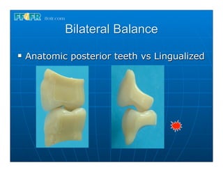 Bilateral Balance
n   Anatomic posterior teeth vs Lingualized
 