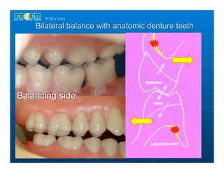 Bilateral balance with anatomic denture teeth




Balancing side
 