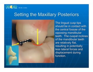 Setting the Maxillary Posteriors
                    The lingual cusp tips
                    should be in contact with
                    the central fossae of the
                    opposing mandibular
                    teeth. The cuspal inclines
                    of the mandibular teeth
                    are relatively flat,
                    resulting in potentially
                    less lateral forces and
                    displacement during
                    function.
 