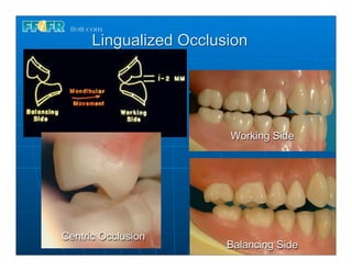 Lingualized Occlusion




                        Working Side




Centric Occlusion
                        Balancing Side
 