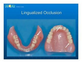 Lingualized Occlusion
 