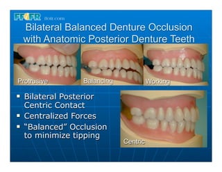 Bilateral Balanced Denture Occlusion
     with Anatomic Posterior Denture Teeth



Protrusive         Balancing             Working

n   Bilateral Posterior
     Centric Contact
n   Centralized Forces
n   “Balanced” Occlusion
     to minimize tipping
                               Centric
 