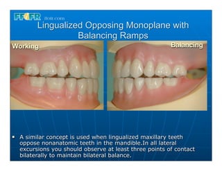 Lingualized Opposing Monoplane with
                     Balancing Ramps
Working                                                   Balancing




n   A similar concept is used when lingualized maxillary teeth
     oppose nonanatomic teeth in the mandible.In all lateral
     excursions you should observe at least three points of contact
     bilaterally to maintain bilateral balance.
 