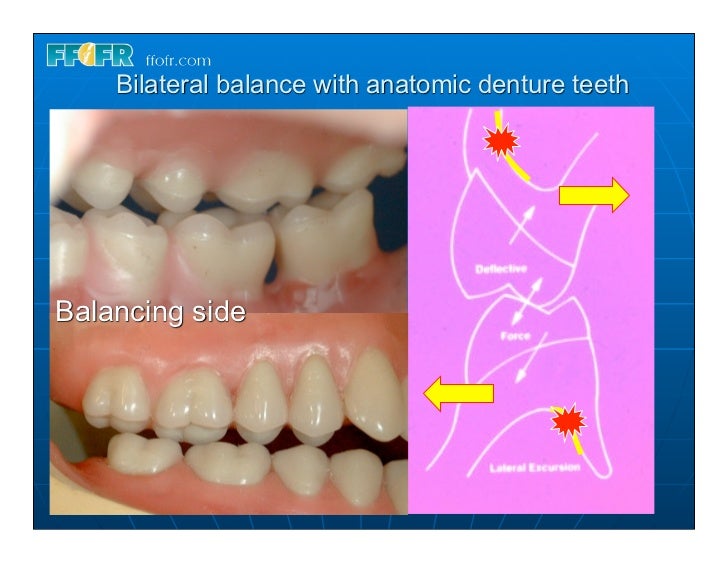 (Replace) 15.concepts of complete denture occlusion
