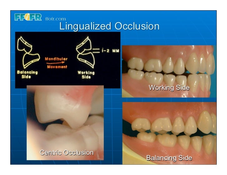(Replace) 15.concepts of complete denture occlusion