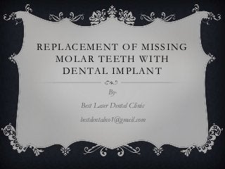 REPLACEMENT OF MISSING
MOLAR TEETH WITH
DENTAL IMPLANT
ByBest Laser Dental Clinic
bestdentalno1@gmail.com

 