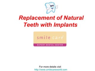 Replacement of Natural Teeth with Implants   For more details visit  http://www.smilecareworld.com 