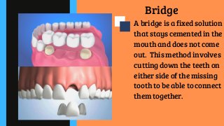 Bridge
A bridge is a fixed solution
that stays cemented in the
mouth and does not come
out.  This method involves
cutting down the teeth on
either side of the missing
tooth to be able to connect
them together.
 