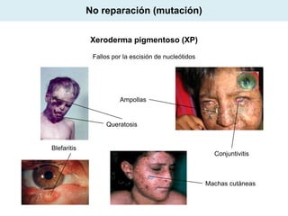 No reparación (mutación)
Xeroderma pigmentoso (XP)
Fallos por la escisión de nucleótidos

Ampollas

Queratosis

Blefaritis

Conjuntivitis

Machas cutáneas

 