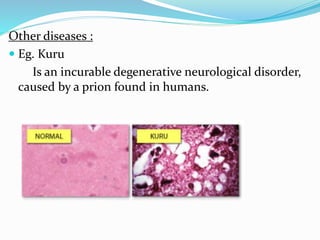 Other diseases :
 Eg. Kuru
Is an incurable degenerative neurological disorder,
caused by a prion found in humans.
 
