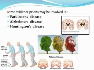 some evidence prions may be involved in:
Parkinsons disease
Alzheimers disease
Huntington’s disease
 