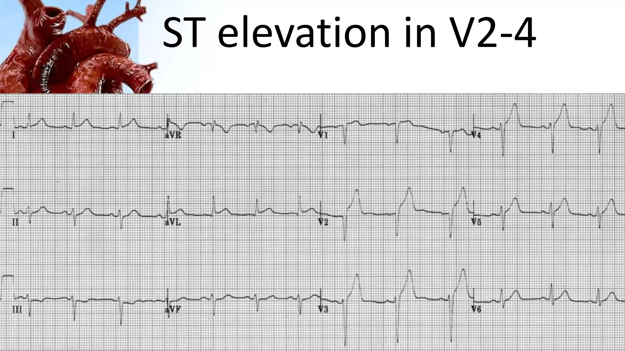 ST elevation in V2-4
 