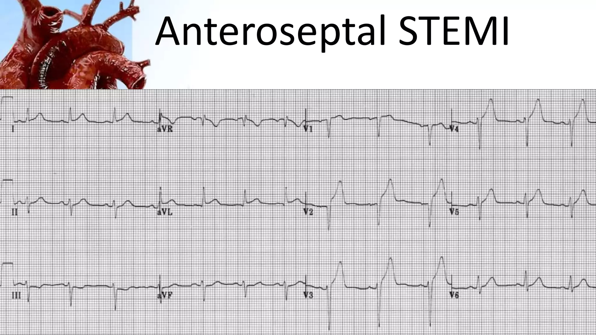 Anteroseptal STEMI
 