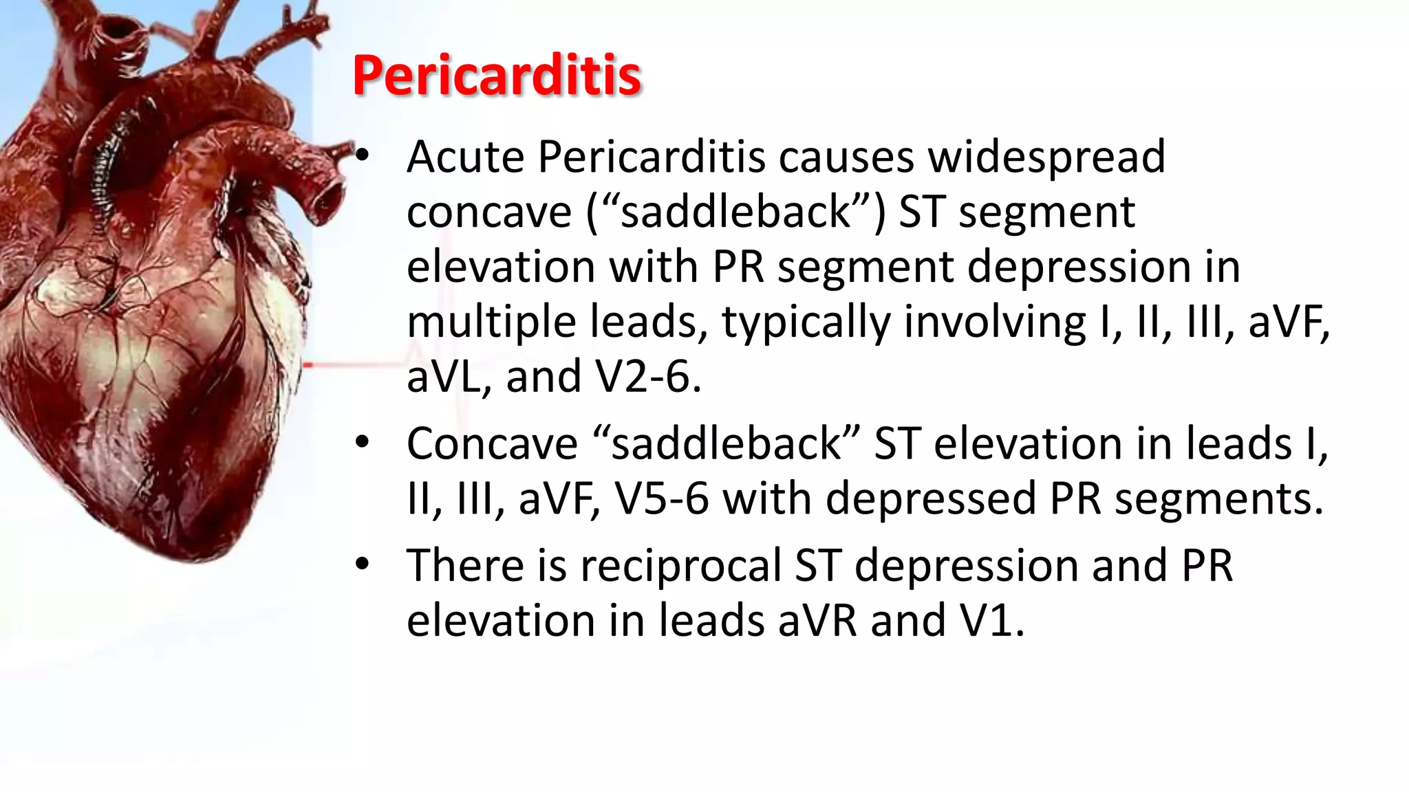 Pericarditis
• Acute Pericarditis causes widespread
concave (“saddleback”) ST segment
elevation with PR segment depression in
multiple leads, typically involving I, II, III, aVF,
aVL, and V2-6.
• Concave “saddleback” ST elevation in leads I,
II, III, aVF, V5-6 with depressed PR segments.
• There is reciprocal ST depression and PR
elevation in leads aVR and V1.
 