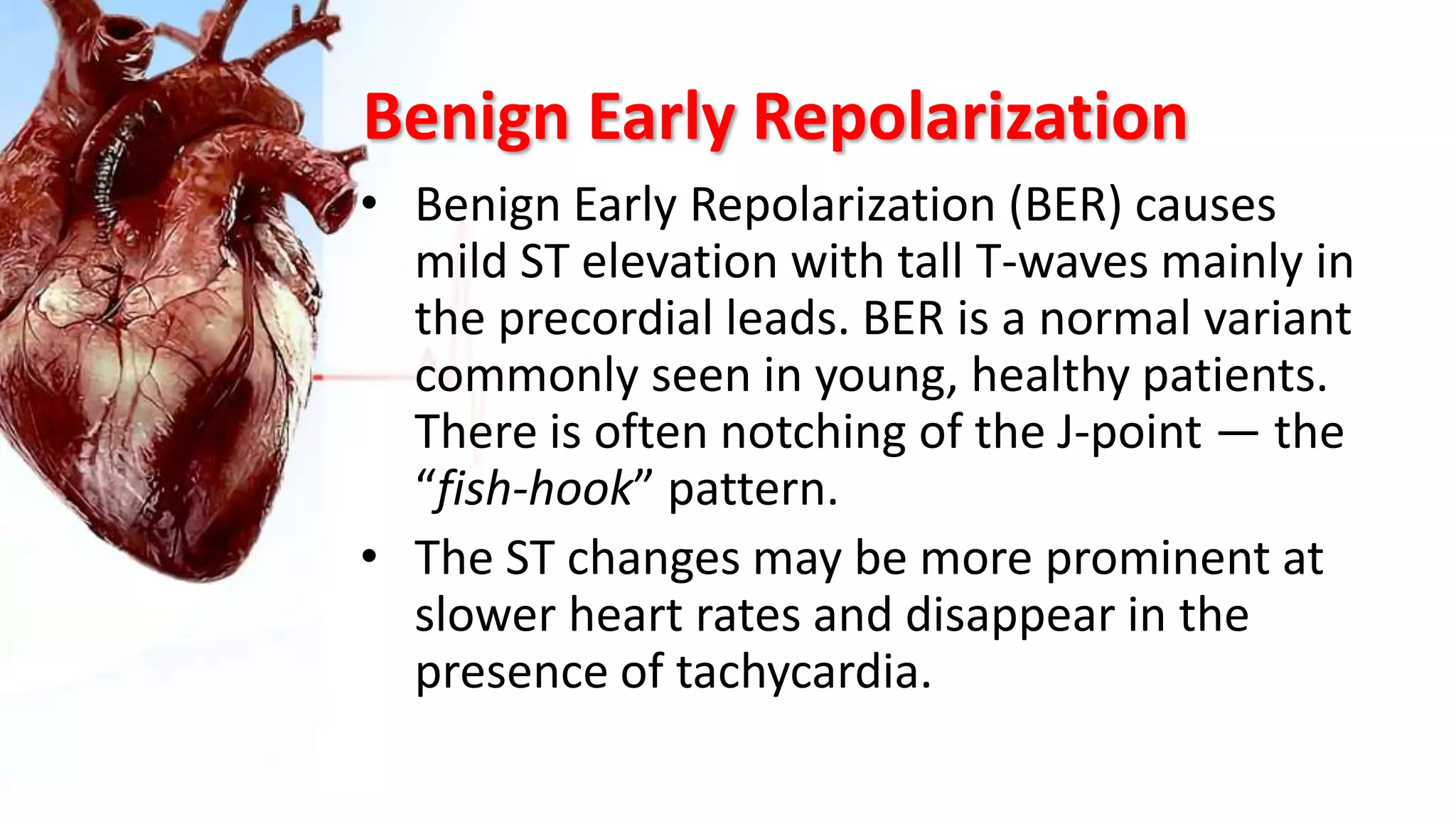 Benign Early Repolarization
• Benign Early Repolarization (BER) causes
mild ST elevation with tall T-waves mainly in
the precordial leads. BER is a normal variant
commonly seen in young, healthy patients.
There is often notching of the J-point — the
“fish-hook” pattern.
• The ST changes may be more prominent at
slower heart rates and disappear in the
presence of tachycardia.
 