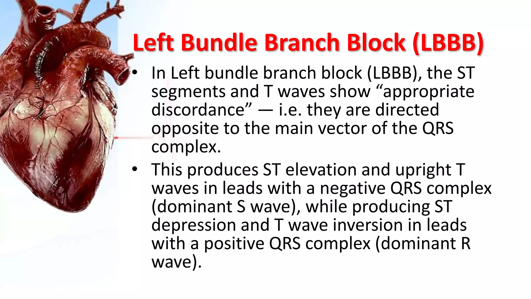 Left Bundle Branch Block (LBBB)
• In Left bundle branch block (LBBB), the ST
segments and T waves show “appropriate
discordance” — i.e. they are directed
opposite to the main vector of the QRS
complex.
• This produces ST elevation and upright T
waves in leads with a negative QRS complex
(dominant S wave), while producing ST
depression and T wave inversion in leads
with a positive QRS complex (dominant R
wave).
 