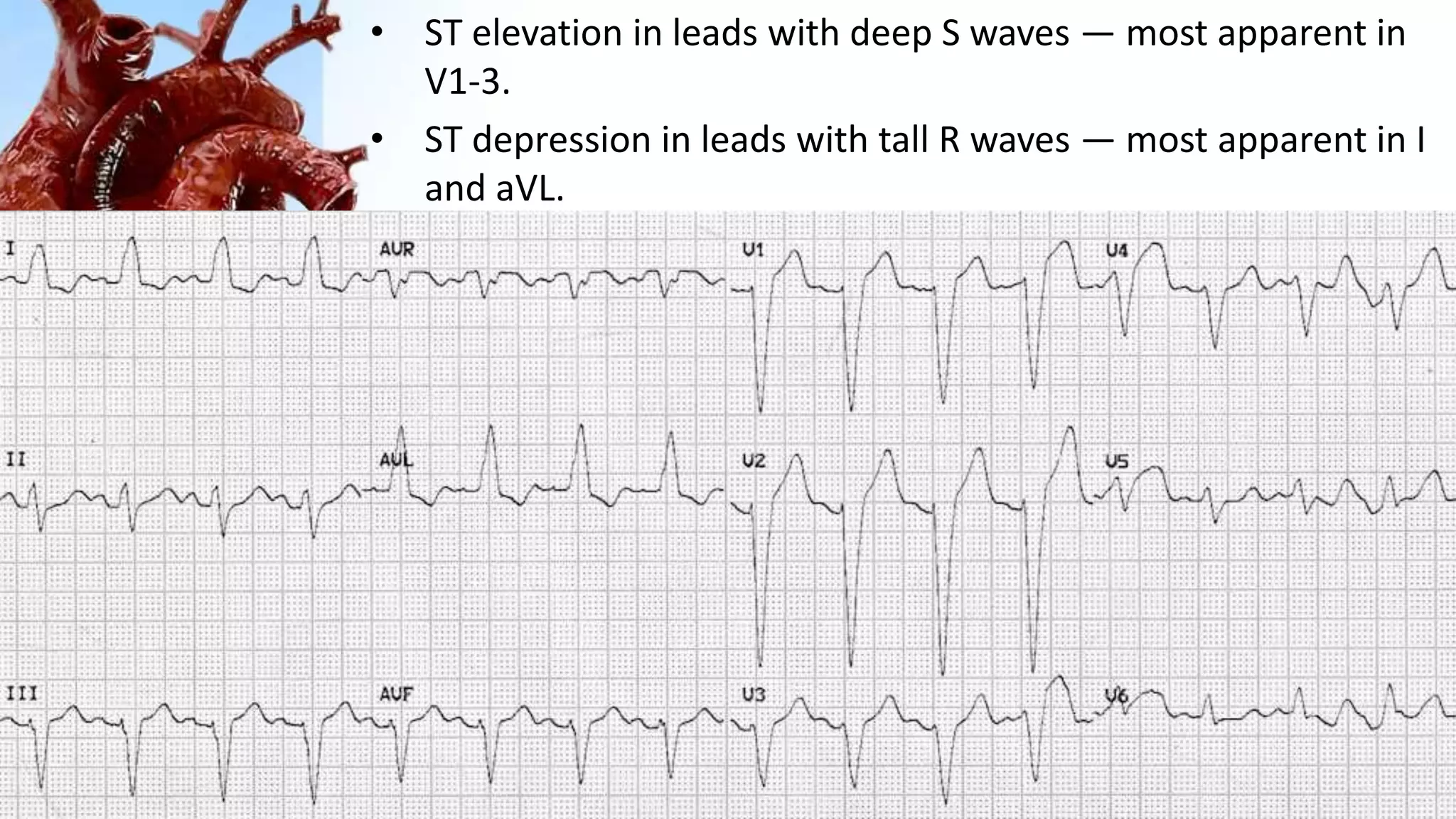 • ST elevation in leads with deep S waves — most apparent in
V1-3.
• ST depression in leads with tall R waves — most apparent in I
and aVL.
 