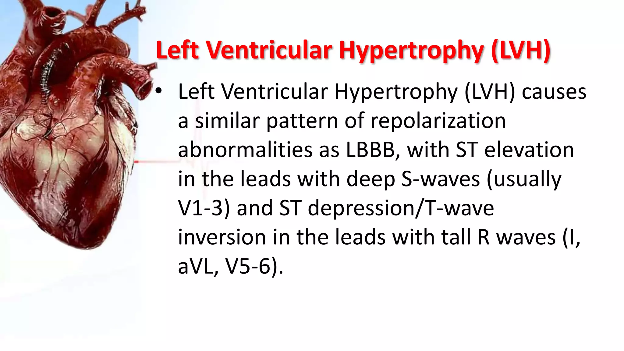 Left Ventricular Hypertrophy (LVH)
• Left Ventricular Hypertrophy (LVH) causes
a similar pattern of repolarization
abnormalities as LBBB, with ST elevation
in the leads with deep S-waves (usually
V1-3) and ST depression/T-wave
inversion in the leads with tall R waves (I,
aVL, V5-6).
 