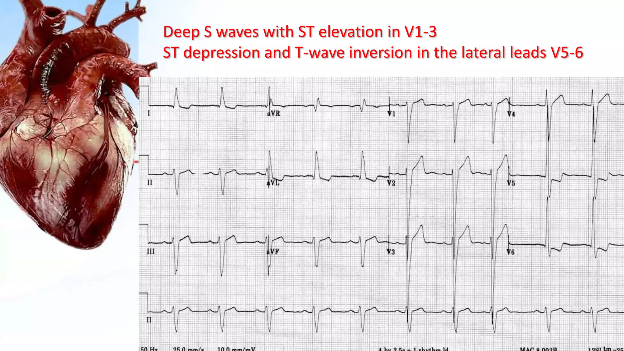 Deep S waves with ST elevation in V1-3
ST depression and T-wave inversion in the lateral leads V5-6
 