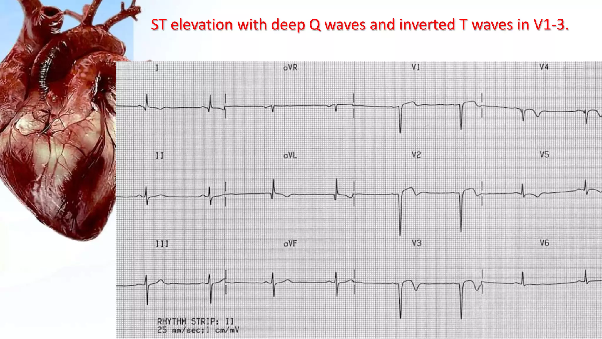 ST elevation with deep Q waves and inverted T waves in V1-3.
 