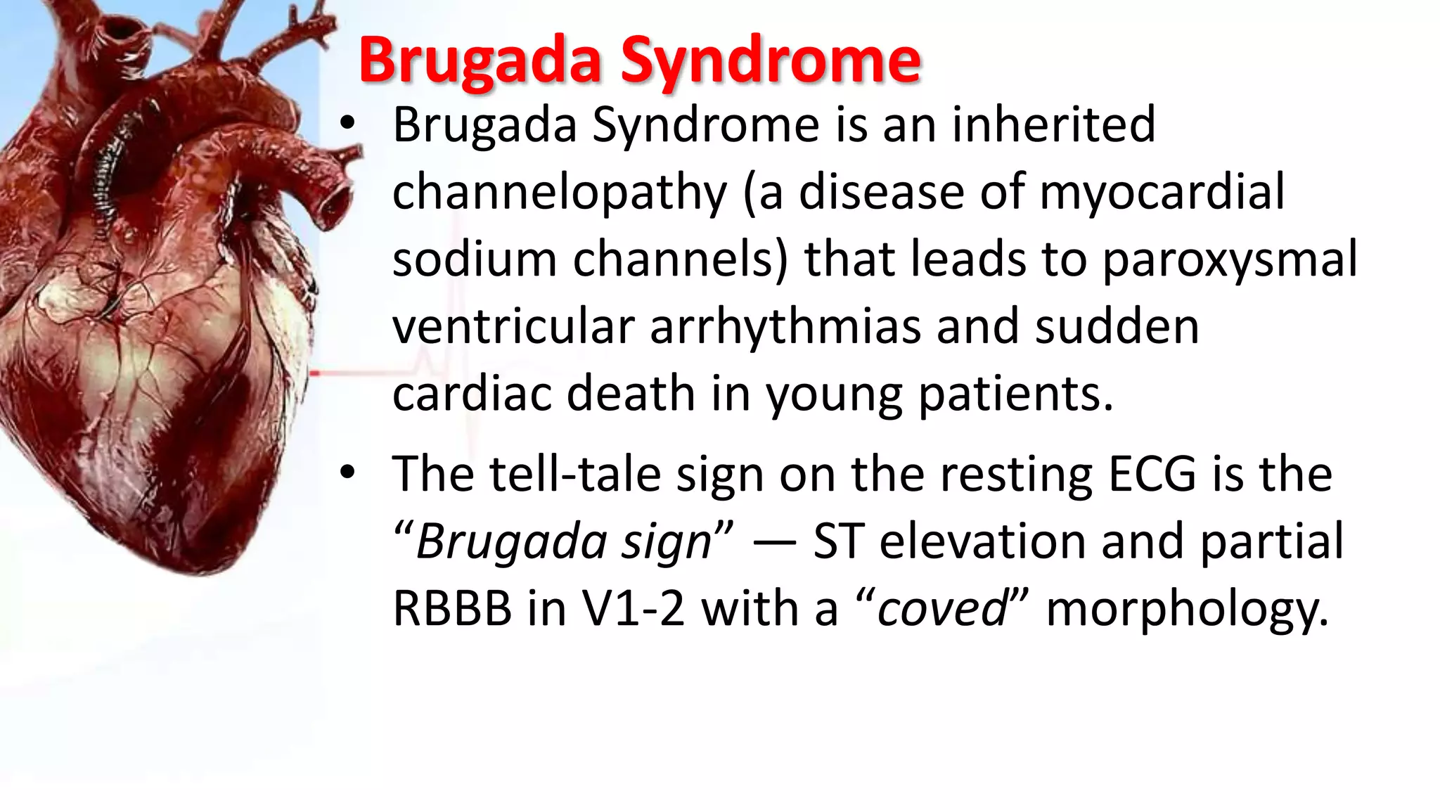 Brugada Syndrome
• Brugada Syndrome is an inherited
channelopathy (a disease of myocardial
sodium channels) that leads to paroxysmal
ventricular arrhythmias and sudden
cardiac death in young patients.
• The tell-tale sign on the resting ECG is the
“Brugada sign” — ST elevation and partial
RBBB in V1-2 with a “coved” morphology.
 