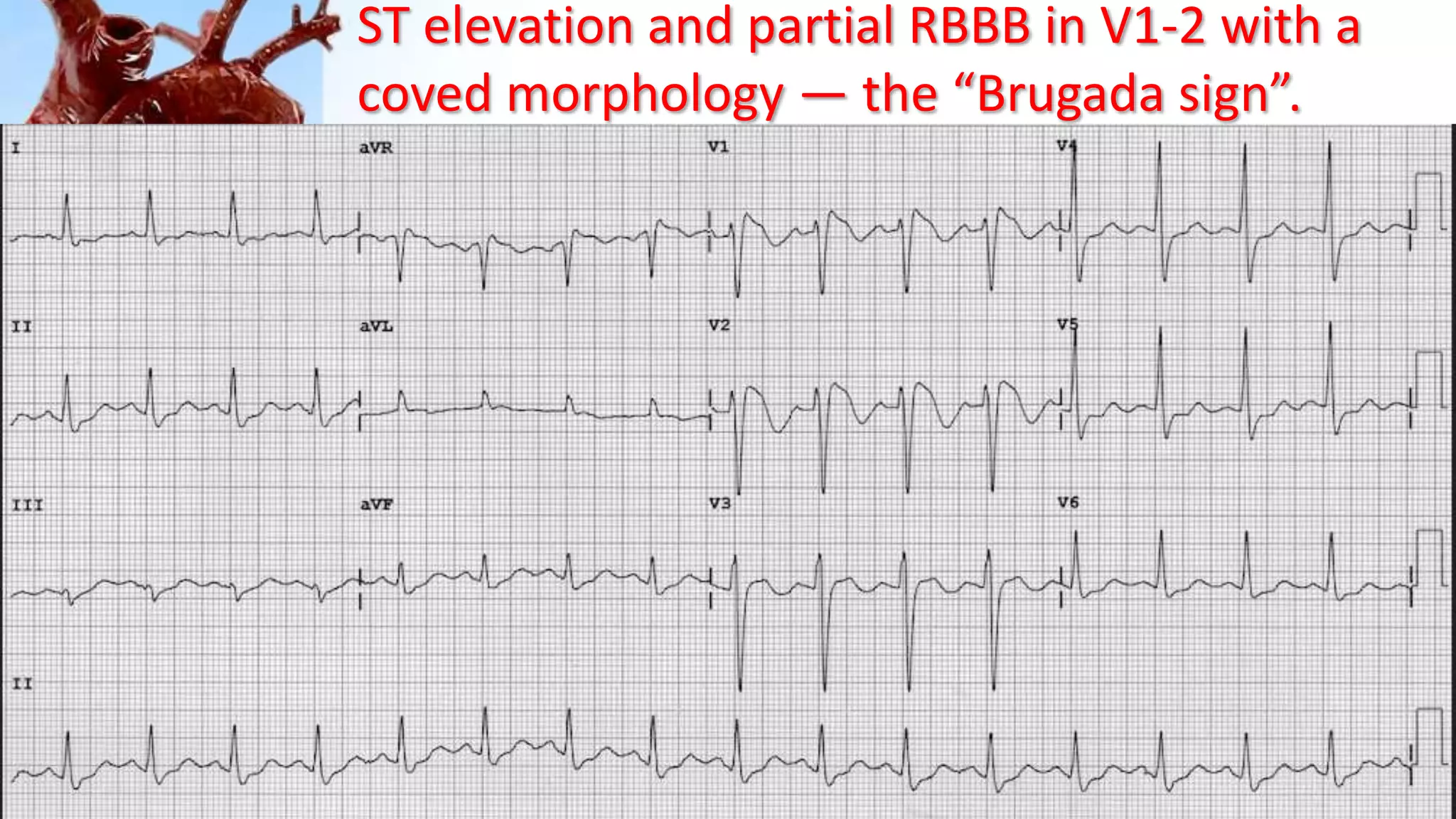 ST elevation and partial RBBB in V1-2 with a
coved morphology — the “Brugada sign”.
 