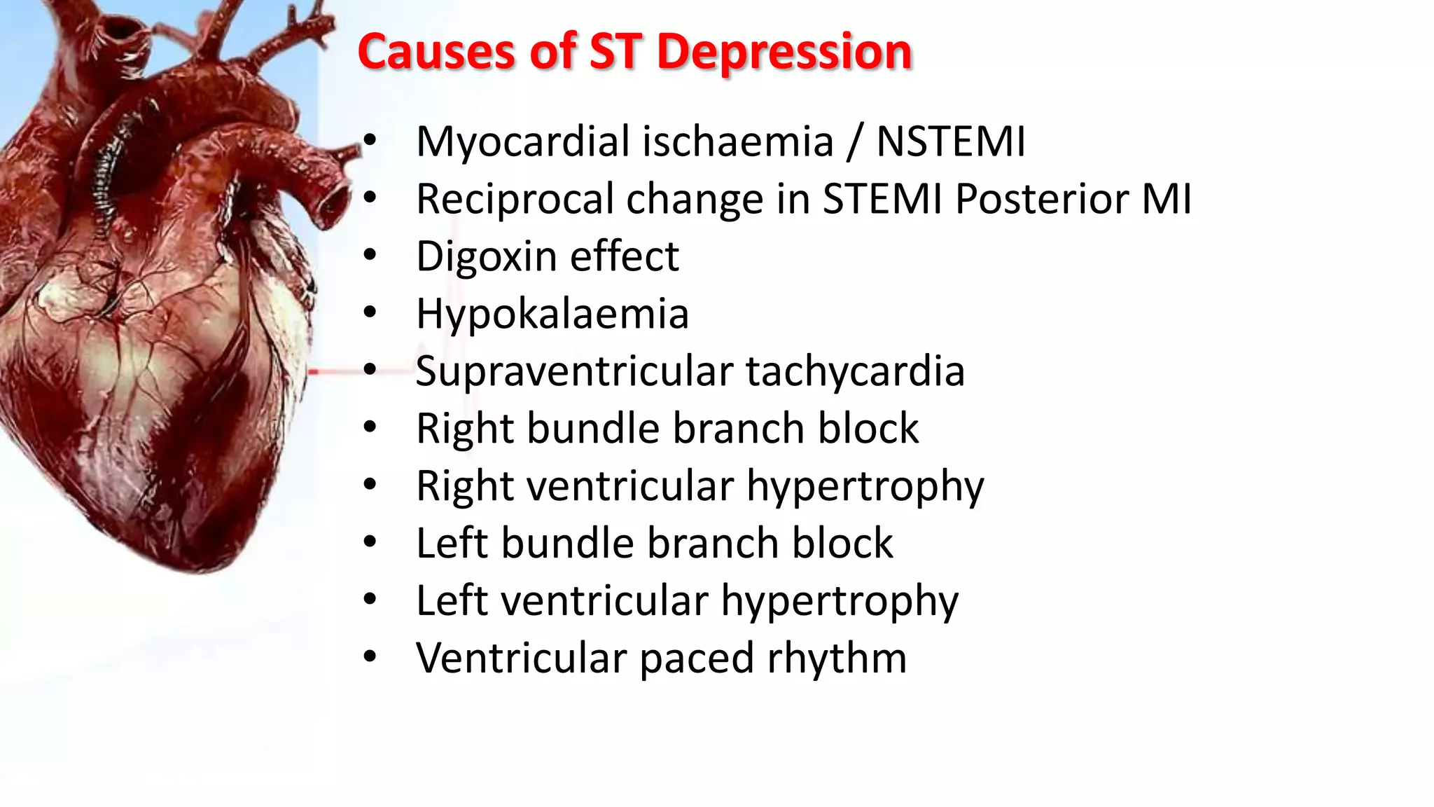Causes of ST Depression
• Myocardial ischaemia / NSTEMI
• Reciprocal change in STEMI Posterior MI
• Digoxin effect
• Hypokalaemia
• Supraventricular tachycardia
• Right bundle branch block
• Right ventricular hypertrophy
• Left bundle branch block
• Left ventricular hypertrophy
• Ventricular paced rhythm
 
