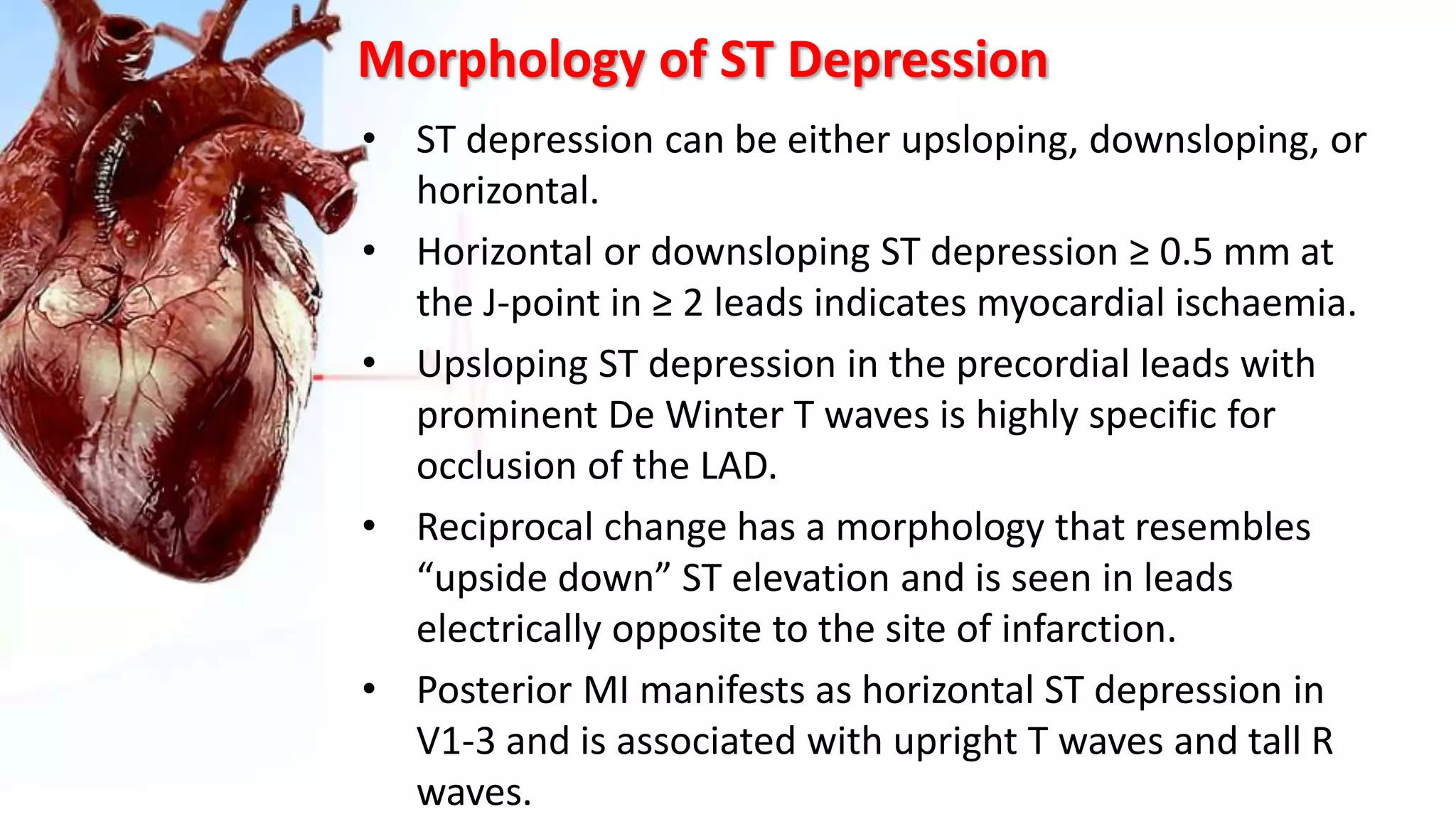 Morphology of ST Depression
• ST depression can be either upsloping, downsloping, or
horizontal.
• Horizontal or downsloping ST depression ≥ 0.5 mm at
the J-point in ≥ 2 leads indicates myocardial ischaemia.
• Upsloping ST depression in the precordial leads with
prominent De Winter T waves is highly specific for
occlusion of the LAD.
• Reciprocal change has a morphology that resembles
“upside down” ST elevation and is seen in leads
electrically opposite to the site of infarction.
• Posterior MI manifests as horizontal ST depression in
V1-3 and is associated with upright T waves and tall R
waves.
 