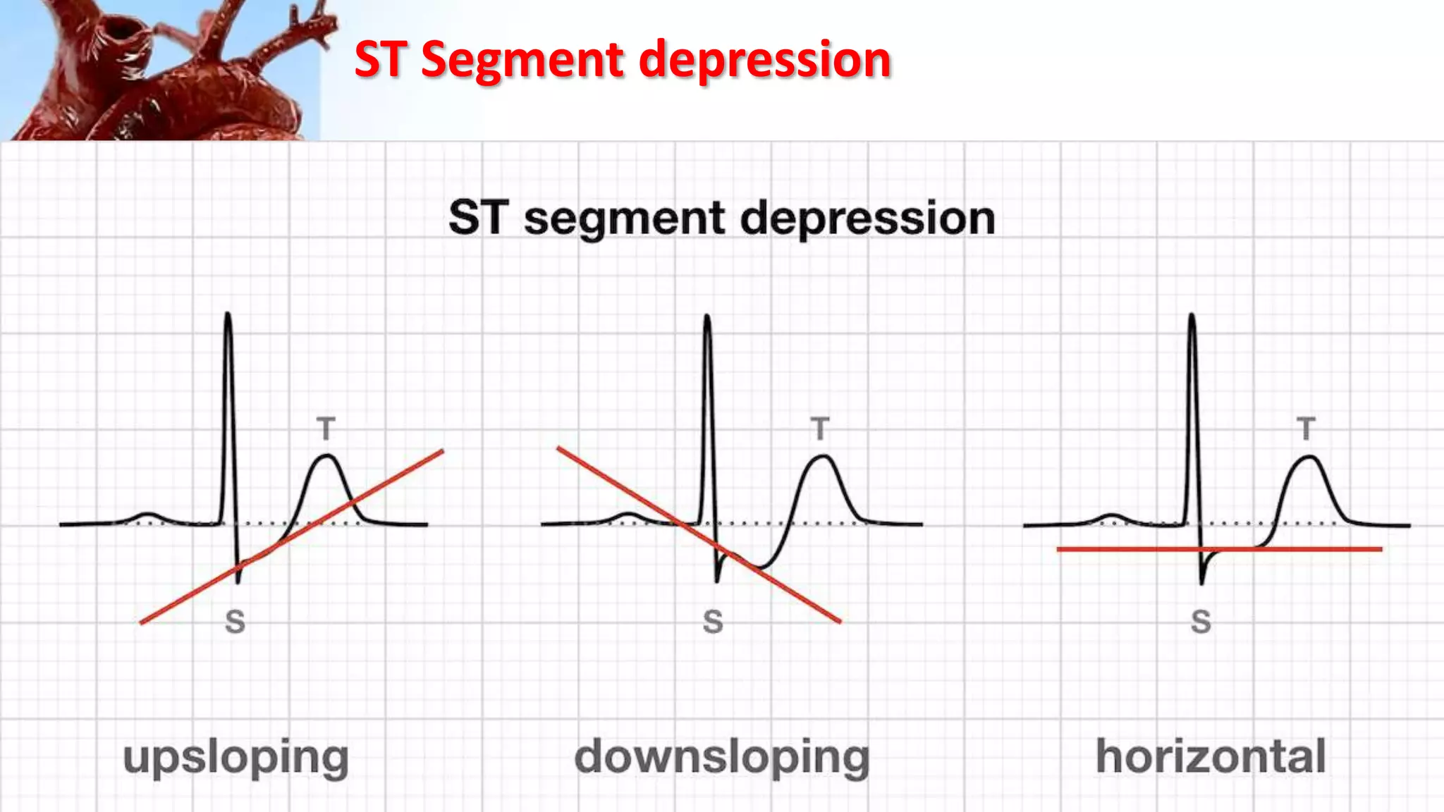 ST Segment depression
•
 