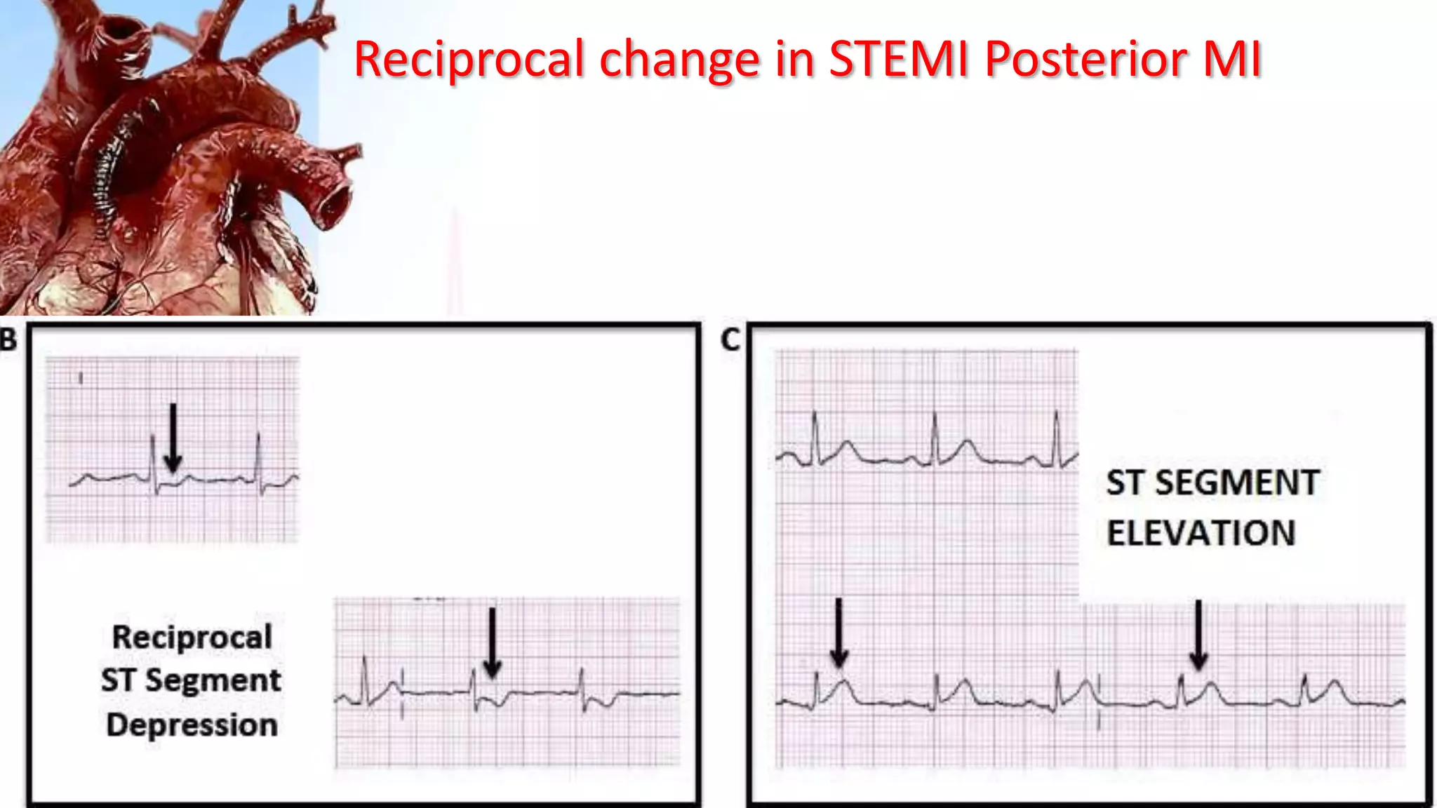 Reciprocal change in STEMI Posterior MI
 
